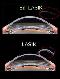lasek-vs-lasik